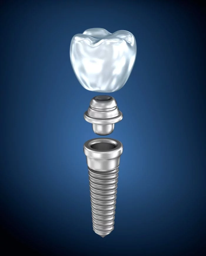 Treatment Options That Use Dental Implants | Virginia Beach