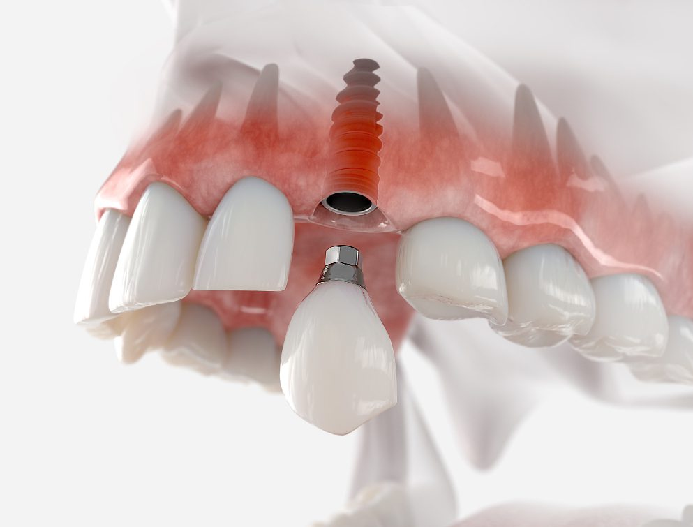 How Long is Too Long to Wait for Dental Implants?